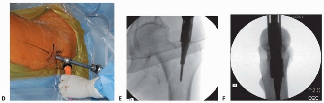 Illustration 23 for Achieve Optimal Femoral Head Fixation with Cephalomedullary Nailing