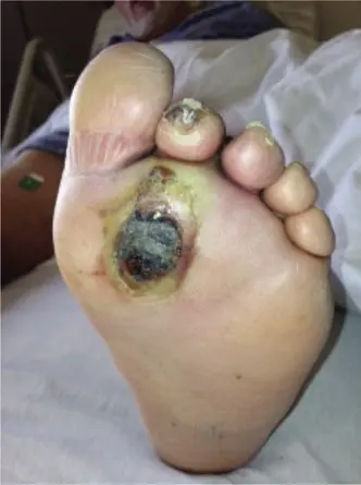 صورة توضيحية لـ قرحة القدم السكرية الملتهبة والحمى: دليل شامل للتشخيص والعلاج في صنعاء