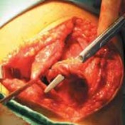 Illustration of proximal patellar realignment - Dr. Mohammed Hutaif