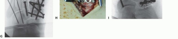 Illustration 25 for Fixation of Lisfranc Injuries: Essential Open Reduction Guide