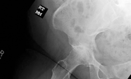 Illustration 3 for Primary Uncemented Total Hip Arthroplasty: A Case Study Title