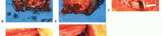 Illustration 7 for Revision Arthroplasty with Acetabular Bone Loss: The Antiprotrusio Cage