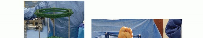 Illustration 24 for Regain Mobility: Surgical Solutions for Charcot Foot Arthropathy