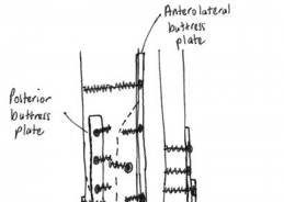Illustration 20 for Decoding Pilon Fractures: Anterolateral and Medial Fragments Revealed