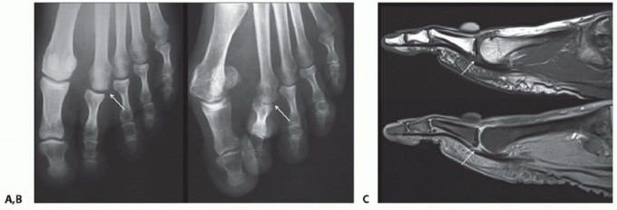 Illustration 8 for Plantar Plate Repair: End Lesser Toe Pain & Instability