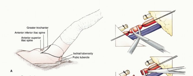 Illustration 8 for Mastering Hip Disarticulation: Through the Hip Joint Capsule