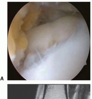 Illustration of autologous chondrocyte transplantation - Dr. Mohammed Hutaif