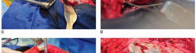 Illustration 7 for Cement in Cement Revision: Simplifying Complex Hip Revisions
