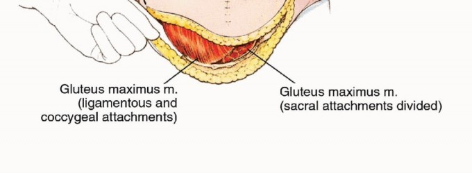 Illustration 16 for Anterior Flap Hemipelvectomy: Leveraging fig tech fig for Difficult Tumors