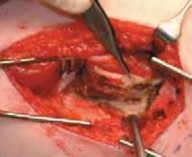 Illustration 9 for Increased Femoral Anteversion: A Proximal Femoral Rotational Osteotomy