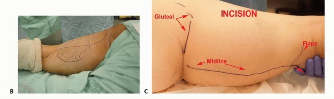 Illustration 9 for Posterior Thigh Resection: Rethinking Outcomes & Limb Sparing