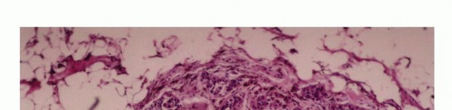 Illustration 26 for Precision Biopsy of Musculoskeletal Tumors for Accurate Diagnosis