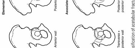 Decoding Acetabulum Fractures & Dislocations: Key Insights