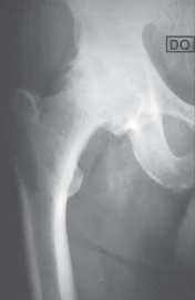 Illustration of uncemented total hip - Dr. Mohammed Hutaif