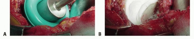 Illustration 12 for Cemented Total Hip: A Successful & Evidence-Based Solution