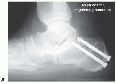 Illustration 30 for Lateral Column Lengthening: Relieve Flatfoot Pain & Correct Deformity
