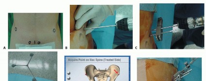 Illustration 19 for Hip Resurfacing: The Bone-Sparing Solution around the Femoral Head