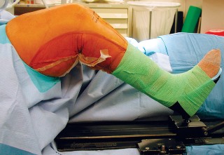 Cementless Fixation: Mastering Techniques & Overcoming Pitfalls