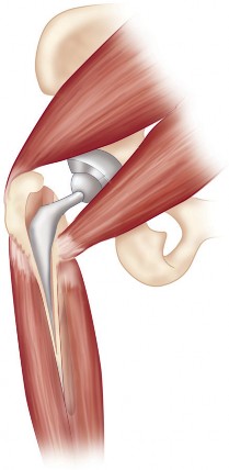 Illustration 7 for Mastering Direct Lateral Exposure for Revision Total Hip Success
