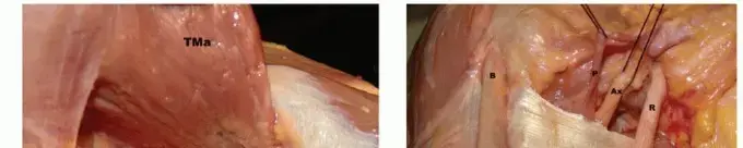 نقل العضلة الظهرية العريضة: حل فعال لتمزقات الكفة المدورة غير القابلة للإصلاح واستعادة حركة كتفك