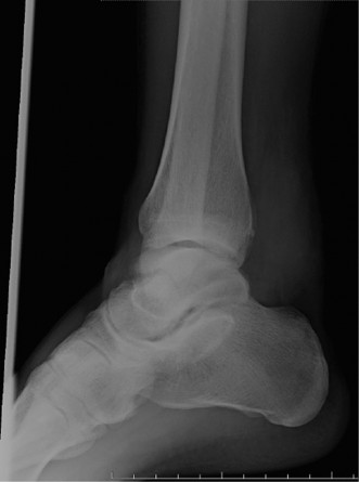 Displaced Talar Neck Fracture: Optimal Treatment Revealed