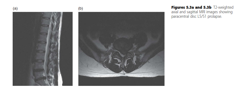 Illustration of cauda equina syndrome - Dr. Mohammed Hutaif