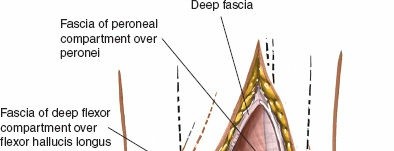 Illustration 70 for Optimized Approaches to the Dorsum of the Foot & Ankle