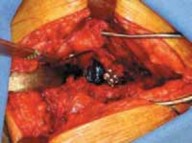 Illustration 25 for Advanced Arthroplasty for Malignant Lesions: Reclaim Your Mobility