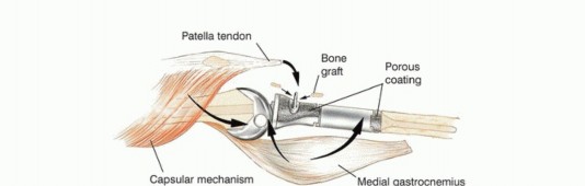 Illustration 33 for Tackling Complex Tumors of the Proximal Tibia: Limb-Sparing Solutions
