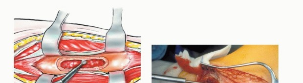 Illustration 19 for Beyond Amputation: The Type I Resection in Fibular Tumor Surgery