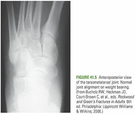 Illustration 18 for Mastering First MTP Joint & Forefoot Fractures: A Comprehensive Guide