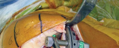 صورة طبية: استبدال مفصل الركبة بالحد الأدنى من التدخل الجراحي: ألم أقل وتعافٍ أسرع مع النهج شبه الرضفي الإنسي