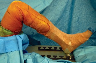 Illustration 23 for Precision Soft Tissue Balancing in Revision: Avoid TKA Pitfalls