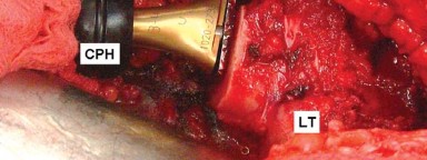 صورة طبية: إتقان توازن الأنسجة الرخوة لمفصل ورك صناعي مثالي: دليل شامل للمرضى مع الأستاذ الدكتور محمد هطيف