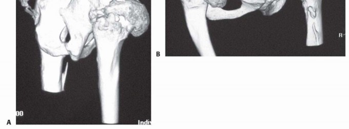 Illustration 3 for Special THA Techniques for Severe Deformities Around the Hip