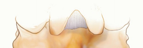 Illustration 2 for Achieve Stability: Posterior Cervical Lateral Mass Screw Fusion