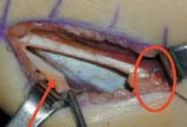 Illustration 7 for Unlocking Mobility: Distal Lengthening for Lateral Hamstring Muscle