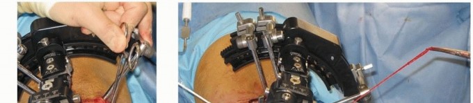 Illustration 6 for Solving Infantile Blount Disease: Surgical Management Strategies