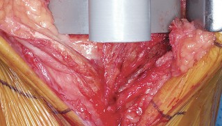 Illustration 46 for Mastering Valgus Total Knee Replacement: Techniques & Pitfalls