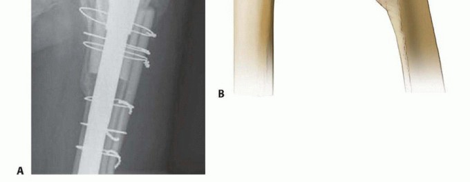 Illustration 12 for Overcoming Proximal Femoral Bone Loss: Fluted Stems in Revision THA