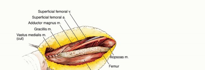 Illustration 21 for Limb-Sparing Quadriceps Resection: Superficial Femoral Artery