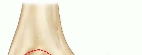 صورة توضيحية لـ كسر اللقيمة الإنسية للمرفق: دليل شامل للمرضى مع الأستاذ الدكتور محمد هطيف