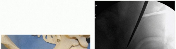 صورة توضيحية لـ جراحة قطع العظم حول الحُق وقطع عظم الفخذ: إعادة محاذاة مفصل الورك لراحة دائمة مع الأستاذ الدكتور محمد هطيف