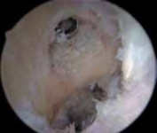 Illustration 10 for Successful Ligament Repair Revision: Fixing Failed ACLs