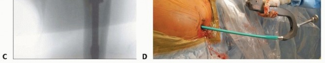 Illustration 26 for Achieve Optimal Femoral Head Fixation with Cephalomedullary Nailing