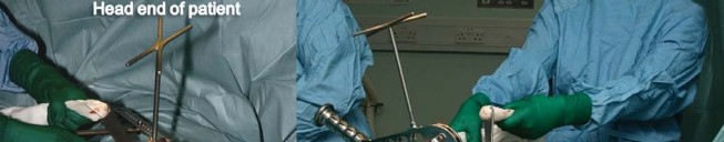 Illustration 59 for Birmingham Hip Resurfacing Designer's Technique for Active Lives