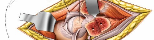 Illustration 136 for Pelvis & Acetabulum Approaches: Unlocking the Posterior Superior Iliac