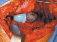 Illustration 26 for Advanced Arthroplasty for Malignant Lesions: Reclaim Your Mobility