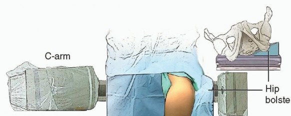 Illustration 8 for Knee Arthrodesis: A Solution for Stable Femur & Tibia Fusion