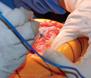 Illustration 38 for Mastering Gap Balancing in Revision TKA: Avoid Common Pitfalls